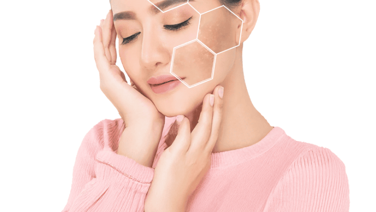 Pigmentation Treatment in Dubai Expert Advice